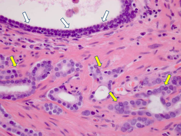 Tumore prostata, cura è efficace anche senza castrazione