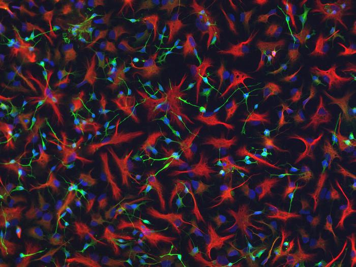 Sclerosi multipla, trapianto staminali per forme gravi